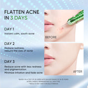 3X Acid Intensive Acne Spot Treatment