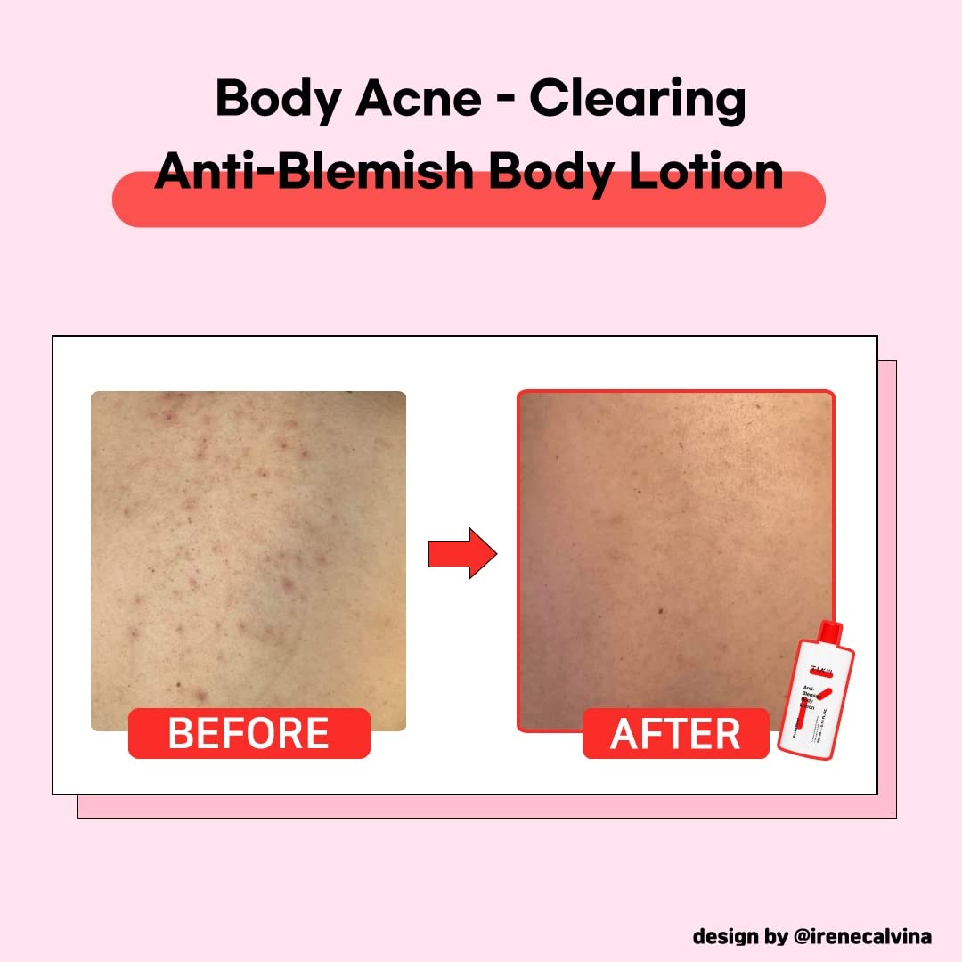 Anti-Blemish Body Lotion 200ml