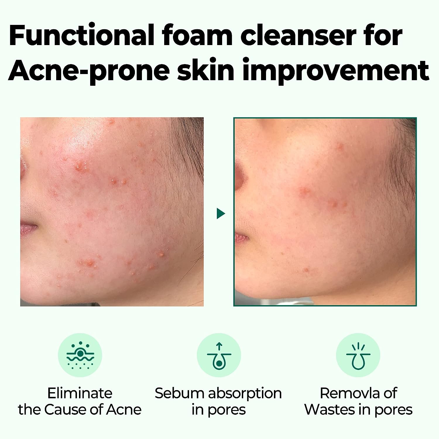 AHA BHA PHA 30 Days Miracle Acne Clear Foam 100ml