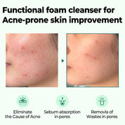AHA BHA PHA 30 Days Miracle Acne Clear Foam 100ml