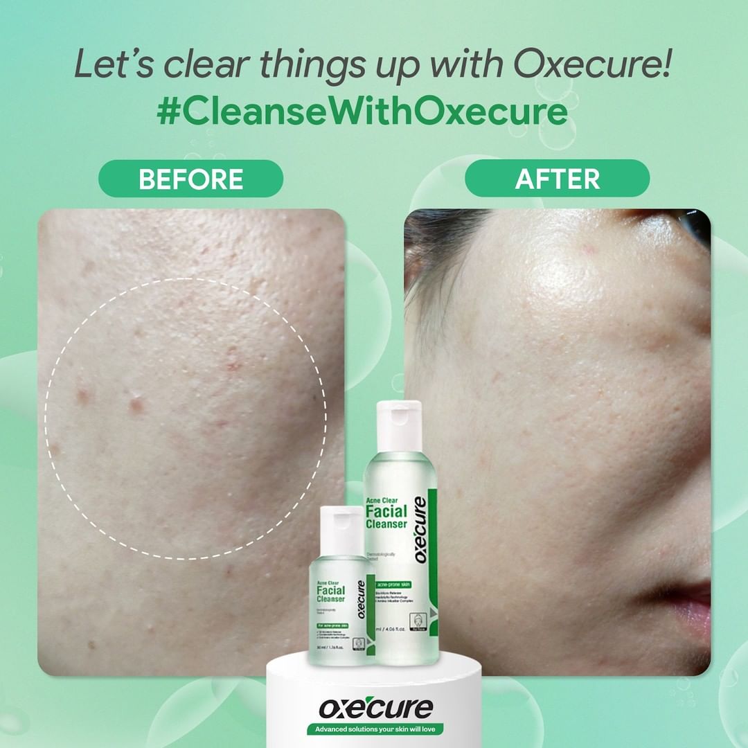 Acne Clear Facial Cleanser 120ml